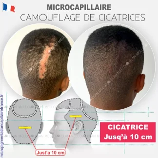 Microcapillaire en Cicatrice du Cuir Chevelu - Jusq’à 10 cm - Micropigmentation Capillaire